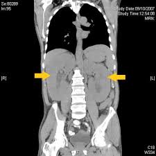 This lymphoma generally develops in the small intestine or colon. Angioimmunoblastic T Cell Lymphoma Ct Wikidoc