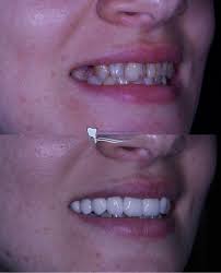 Daha bir dəyişim … 🤩 Nəzərinizə çatdıraq ki, pasiyentin müalicəsi  hal-haxırda davam edir. Bu hələ yekun vəziyyət deyil. Son vəziyyəti görmək  üçün izləmədə qalın 😉 Ağız boşluğu və diş sağlamlığınızı bizə etibar