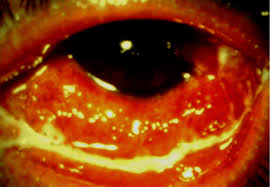 Image result for Gonococcal Conjunctivitis