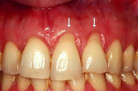 What causes receding gums and your treatment options? How To Treat And Prevent Receding Gums Dentist In San Rafael Ca
