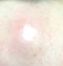 Boutons sous la peau : Enorme Bouton Bosse Besoin D Aide Urgent Beaute De La Peau Forum Beaute Doctissimo