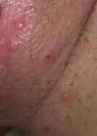 An infected person with sores present has an increased risk that exposure to hiv will lead to infection because the sores provide an entry point for the aids virus. Short Story Long Story I Know I Have Hsv Now What Genital Herpes Simplex Forums Patient