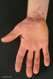 Am scapat de lichen plan. Lichen Planus Klassischer Typ Altmeyers Enzyklopadie Fachbereich Dermatologie