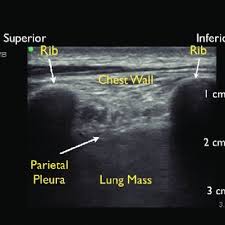 Pleural effusion is a condition in which excess fluid builds around the lung. Ultrasound Of A Loculated Pleural Effusion This Ultrasound Was Taken Download Scientific Diagram