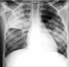 The most common one is streptococcus (pneumococcus), but other bacteria can cause it too. Neumonias Adquiridas En La Comunidad En Ninos Diagnostico Por Imagenes Sciencedirect