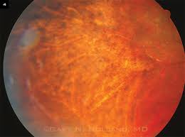 Image result for HIV Retinitis