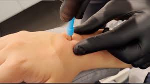 Image result for Blue Nevus