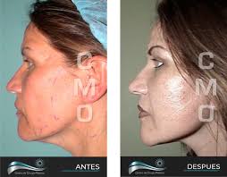 Rejuvenecimiento Facial