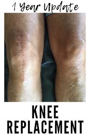 Pin On Knee Replacement
