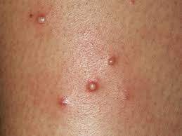 The usual color change is from your natural color to gray. Folliculitis Hot Tub Rash In Children Babycenter