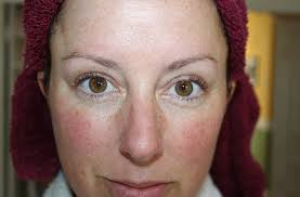 Image result for demodex rosacea