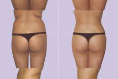 Zekerheid Bij Liposuctie En Liposculptuur Parkkliniek Rotterdam