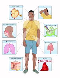 Symptoms begin with fever, headache, muscle pains, swollen lymph nodes, and feeling tired. Viruses Free Full Text Improving The Care And Treatment Of Monkeypox Patients In Low Resource Settings Applying Evidence From Contemporary Biomedical And Smallpox Biodefense Research