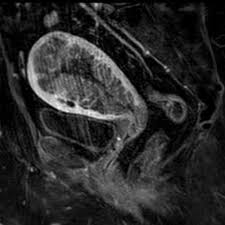 An endocervical polyp is a type of growth that appears in the neck of a woman's uterus, which is called the cervix. Cervical Polyp More Than Just What The Eye Can See Eurorad