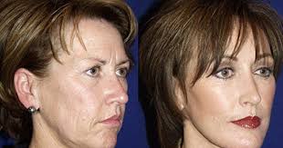 The Carlotti Cosmetic Surgery Center Is Scottsdale Arizona S Leading Face Lift And Cosmetic Surgeons In The Cosmetic Surgery Plastic Surgery Cosmetic Surgeon