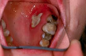 Image result for Canker sores symptoms roof of the mouth