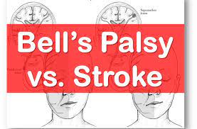 They can look similar, but it's important to tell them apart ems world. The Difference Between Bell S Palsy And Stroke