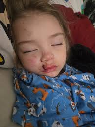 Fundraiser by Windy Manning : Help Echo Heal After a Dog Attack