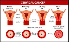 The earlier precancerous cells or cancer is found and treated, the better the chance that the cancer can be prevented or cured. Cervical Cancer Screening Hospital In Lucknow