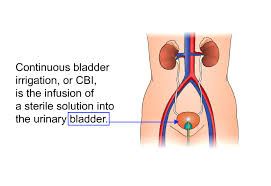 Image result for Bladder Irrigation