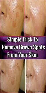 How To Remove Brown Spots From Your Skin Skin Name Brown Spots On Face Spots On Face Brown Spots Removal