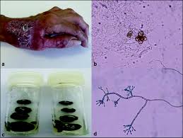 Monophora are agents of chromoblastomycosis fonsecaea monophora (fig. Chromoblastomycosis Clinical And Microbiological Characteristics Of A Neglected Disease