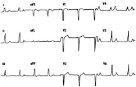 Normally, the heartbeat begins at the sinoatrial (sa) in 1930, wolff, parkinson and white described a distinct electrocardiograph (ecg) pattern in. Wolff Parkinson White Syndrome In A Patient Having A Right Anteroseptal Download Scientific Diagram