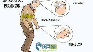 También describen el temblor esencial (llamado también. Parkinson Youtube