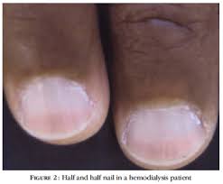 Nail Disorders In Patients With Chronic Renal Failure Undergoing Hemodialysis