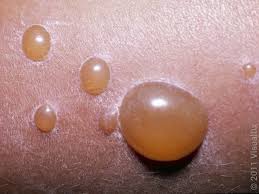 Image result for Impetigo