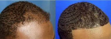 Arocha hair restoration & transplant center offers the latest in hair treatment. African American Hair Transplant In Miami Care4hair
