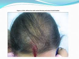 Monat is a beauty brand that develops and sells hair care and skin care products. Hair Thinning In Women