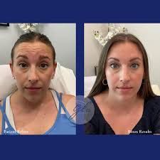 A little bit of tox goes a long way 💉 Just ask our very own RN, Paula  Kowgios, who helped this beauty achieve these natural enhancing looks with  just one appointment✨ Call