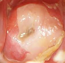 Escharotic Treatment Case Studies Treatment For Cervical Dysplasia Dr Nick Leroy