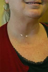 Scar Gallery Parathyroid Surgery Thyroid Laparoscopic Adrenal Scars Ucla Endocrine Center Los Angeles Ca
