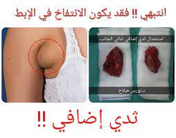 انتفاخ تحت الابط كونتنت