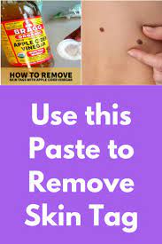 Use This Paste To Remove Skin Tag This Home Remedy Will Remove Skin Tag Easily At Home The Skin Tag Removal Skin Tags Home Remedies Remove Skin Tags Naturally