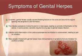 Image result for genital herpes