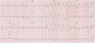 Ecgs show only episodes of sinus tachy w/ normal resting rate. Fulminant Dengue Myocarditis Masquerading As Acute Myocardial Infarction International Journal Of Cardiology