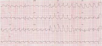 Ecgs show only episodes of sinus tachy w/ normal resting rate. Fulminant Dengue Myocarditis Masquerading As Acute Myocardial Infarction International Journal Of Cardiology