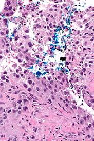 Breast surgeon a doctor specialising in surgery of the breast. Surgical Margins Libre Pathology