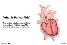 Image result for Pericarditis