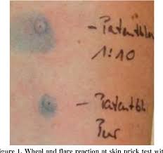 Fricker m, helbling a, schwartz l, muller u. A Case Of Anaphylaxis To Patent Blue In A Patient With Sentinel Lymph Node Excision Semantic Scholar