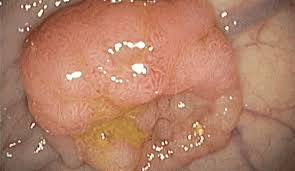 Anyone who receives a diagnosis of stage 4 colon cancer should work closely with their medical team to discuss all the treatment options and decide what will best suit their needs. No Os Benefit Of Immunotherapy Plus Mek Inhibitor For Patients With Microsatellite Stable Metastatic Colorectal Cancer Cancer Therapy Advisor