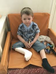Hier die übersetzung englisch ↔ deutsch für clubfoot nachschlagen! Aleksandr Has Congenital Clubfoot Lads