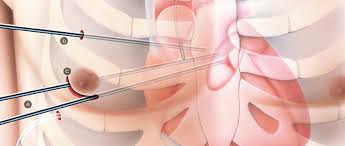 Maybe you would like to learn more about one of these? Schlusselloch Chirurgie Am Herz Hirslanden