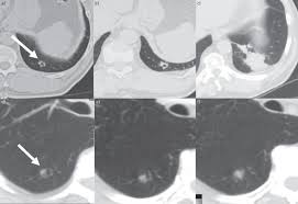 The heart, lungs, kidneys, and liver are at risk of major damage from untreated how long do dogs with cancer live? Slow Growing Lung Cancer As An Emerging Entity From Screening To Clinical Management European Respiratory Society