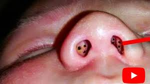 Träufeln sie ein paar tropfen olivenöl in die nasenlöcher und massieren sie es gut ein. Schwarze Flecken In Der Nase Was Es Nicht So Alles Gibt