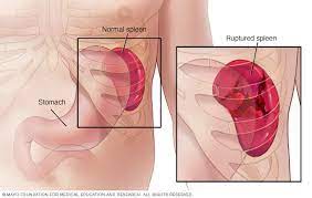 Signs of a ruptured spleen are: Ruptured Spleen Symptoms And Causes Mayo Clinic