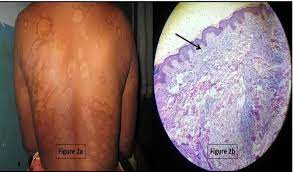 Borderline leprosy and the subtypes are characterized by more extensive disease than polar tuberculoid, with more numerous skin lesions and more nerve involvement, but not as widespread disease as in lepromatous leprosy. Borderline Lepromatous Leprosy A Borderline Lepromatous Leprosy Download Scientific Diagram